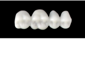 Cod.EXUPPER RIGHT : 15x  posterior hollow wax veneers-bridges, X-LARGE, (44-47), with precarved occlusion to Cod.EXLOWER RIGHT, and compatible to Cod.SXUPPER RIGHT  (solid), (44-47)